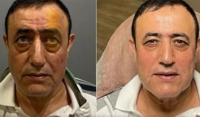 Mahmut Tuncer de estetik operasyon geçirdi