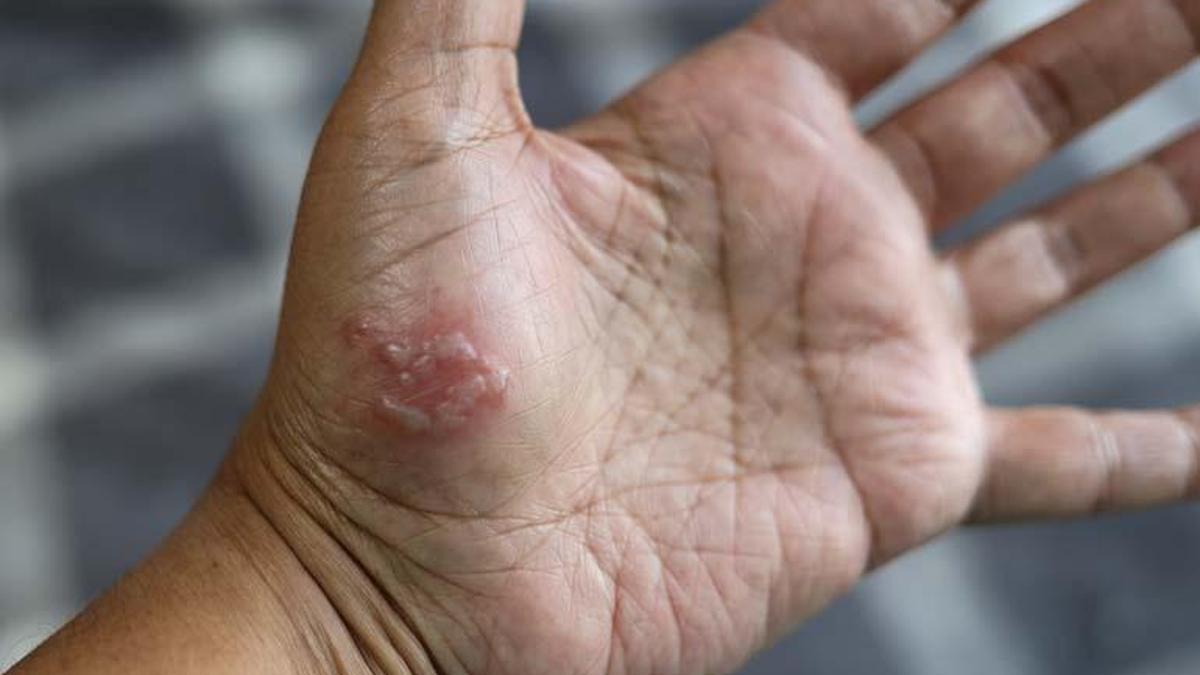 Her 3 kişiden 1’i zona oluyor! Teşhiste geç kalınırsa duyma ve görme kaybına neden olabilir…